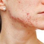 Acne and Acne Scarring