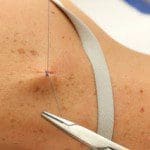 Surgical Dermatology Closing