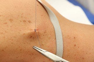 Surgical Dermatology Closing
