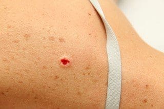 Surgical Dermatology Removal
