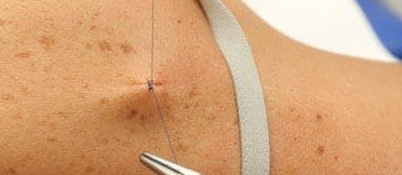 Surgical Dermatology Closing